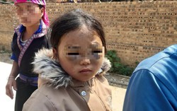 Công an vào cuộc điều tra vụ bé gái lớp 1 nghi bị cô giáo đánh tím mắt