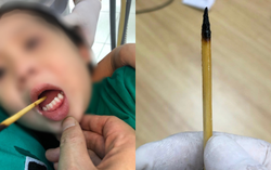 Ngã lúc chơi đùa, bé gái 3 tuổi bị que xiên thịt đâm xuyên lưỡi