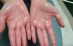 Trời nóng dễ đổ mồ hôi nhưng bác sĩ nhắc nhở 7 kiểu này là bệnh, gồm cả ung thư