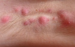 Mẩn ngứa da vùng nách do đâu?