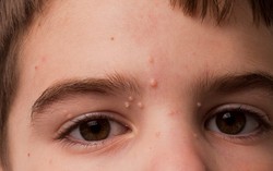 U mềm lây: Nguyên nhân, triệu chứng, giai đoạn và cách điều trị