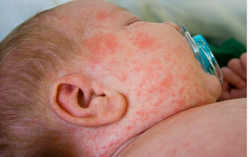 Nhiều trẻ mắc sởi, TPHCM kêu gọi phụ huynh cho con đi tiêm vaccine