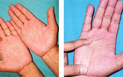 Lòng bàn tay đỏ và nóng là dấu hiệu của bệnh gì? Có nguy hiểm không?