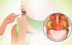 1 người tử vong do bệnh bạch hầu, Bộ Y tế yêu cầu tăng cường phòng, chống, không để bệnh lây lan trên diện rộng