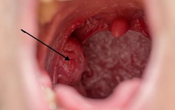 Người đàn ông bất ngờ phát hiện mắc ung thư ở miệng vì chủng virus anh nghĩ chỉ gây bệnh cho phụ nữ