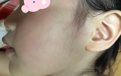 Công an tiếp nhận đơn tố giác về việc cô giáo mầm non tát bé gái 4 tuổi gây chấn thương