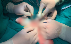 Nối lại vùng kín bị đứt lìa cho bệnh nhi 9 tuổi