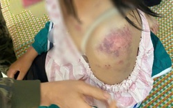 Vụ bé gái 13 tuổi bị bạo hành: Hành trình chạy trốn khỏi trận đòn sinh tử