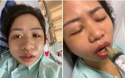 Vụ chó gây tai nạn ở Lào Cai: Công an xã Bảo Hà tiếp tục xác minh sau phản ánh