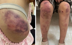 Vụ bé gái 13 tuổi bị bạo hành dã man ở Thái Nguyên: Vì sao tỷ lệ tổn thương cơ thể chỉ 5%?