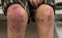 Cục Bà mẹ và Trẻ em can thiệp và hỗ trợ bé gái 13 tuổi bị bạo hành ở Thái Nguyên