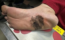 Nhiều người đổ xô đi khám vì lo sợ ung thư tế bào hắc tố gan chân