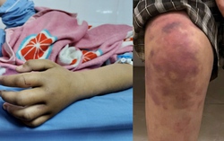 Bé gái 13 tuổi ở Thái Nguyên bị bạo hành: Lời nhắc nhở mạnh mẽ về trách nhiệm của chính quyền cơ sở