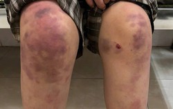 Bé gái 13 tuổi bị bạo hành ở Thái Nguyên mong được về sống cùng dì