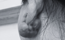 Sẹo ở tai phì đại, lở loét bất thường vì chần chừ đi khám