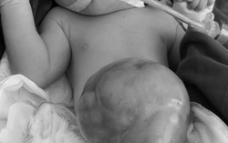 Bé sơ sinh mang khối thoát vị chứa hầu như toàn bộ gan và ruột trên bụng