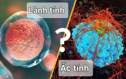 Khối u lành tính có thể phát triển thành ác tính không?