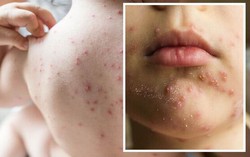 Những điều cần biết về bệnh thủy đậu ở trẻ em