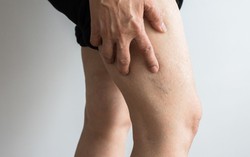 Cục máu đông ở chân: Dấu hiệu nhận biết và cách điều trị