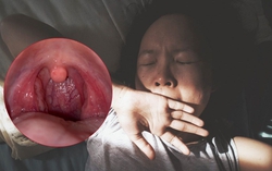 Đau họng khi ngáp là bệnh gì, có nguy hiểm không?