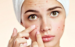 Nguy cơ tử vong từ thói quen tự nặn mụn