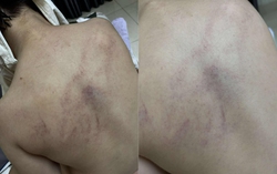 Vụ bé gái 4 tuổi bị kéo lê, ném vào tường: Tạm đình chỉ 2 giáo viên để phục vụ điều tra