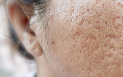 “Sẹo rỗ - Hiểu đúng, trị chuẩn”: Tránh “tiền mất tật mang” nhờ lời khuyên từ đội ngũ bác sĩ da liễu tại HKmedi