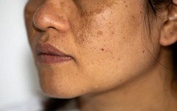 Sau tuổi 35, trị nám ở đâu để vừa an toàn vừa hiệu quả lâu dài?