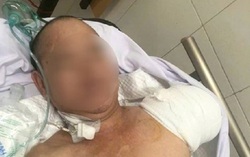 Tự đắp lá cây trị mụn, người đàn ông phải cắt cụt cánh tay vì nhiễm trùng