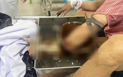 Tai nạn trong sản xuất, bàn tay nam công nhân bị cuốn vào máy xay thịt