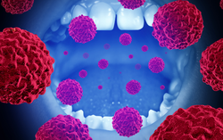 Ăn mặn, cay thời gian dài gây tổn thương mạn tính niêm mạc khoang miệng, dễ dẫn đến ung thư