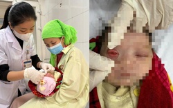 Bé 1 tháng tuổi nhập viện vì bị nhỏ sữa mẹ và nước cốt chanh vào mắt
