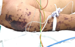 Bất ngờ sốc nhiễm khuẩn nguy kịch sau 48 giờ ăn cỗ