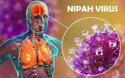 Người mắc virus Nipah sẽ có những biểu hiện như thế nào?