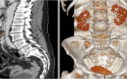 Nước tiểu có bọt bất thường, người phụ nữ đến MEDLATEC khám, phát hiện mắc hội chứng kẹp hạt dẻ hiếm gặp
