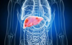 Cách phục hồi gan sau rượu bia ngày Tết Nguyên đán