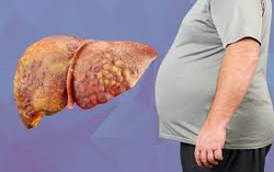 "Tế bào già ngừng phân chia" đẩy nhanh bệnh gan nhiễm mỡ