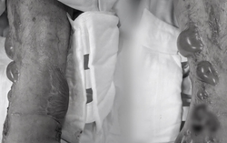 Cảnh báo nguy cơ nhiễm trùng, hoại tử do thói quen tự đắp thuốc dân gian chữa bệnh