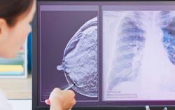 Chuyên gia quốc tế chỉ rõ những yếu tố làm tăng nguy cơ mắc ung thư vú