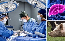 Dùng gan lợn biến đổi gen điều trị bệnh suy gan