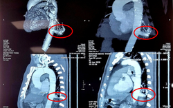 Lần đầu tại Việt Nam: Sử dụng robot phẫu thuật cho bệnh nhân phổi biệt lập nội thùy