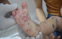 TPHCM ghi nhận 3 ca tử vong do tay chân miệng đầu tiên năm 2026
