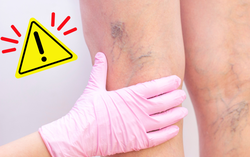 Tính mạng bị đe dọa vì giãn tĩnh mạch chi dưới khi mang thai