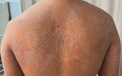 Nấm da nghiêm trọng vì bôi "kem gia truyền"