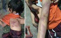 Học sinh lớp 2 dùng thước đánh bạn bầm tím khắp người