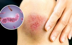 Cục Phòng bệnh khuyến cáo 8 biện pháp "né" bệnh Whitmore