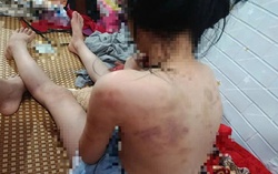 Nữ sinh lớp 4 bị nhóm bạn hành hung, cơ thể nhiều vết thâm tím