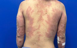 Nữ bệnh nhân dân tộc Mông đau đớn vì căn bệnh vảy nến mủ toàn thân
