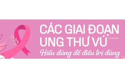 Ung thư vú: Hiểu đúng về các giai đoạn bệnh