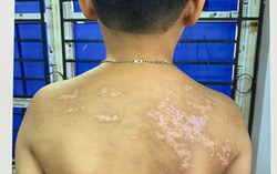 Bé trai 7 tuổi bị cha ruột đánh bằng dây sạc, thương tích 36%